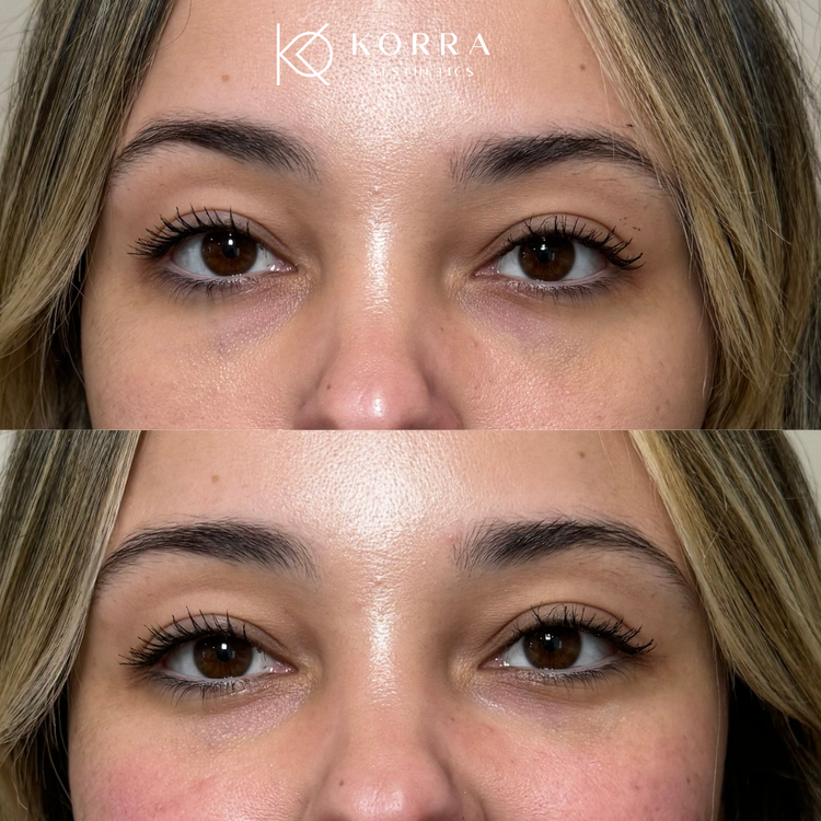 Before & Immediately After 1 Syringe of Restylane Eyelight