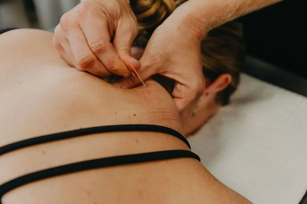 What to Expect From Acupuncture at The Good Joint