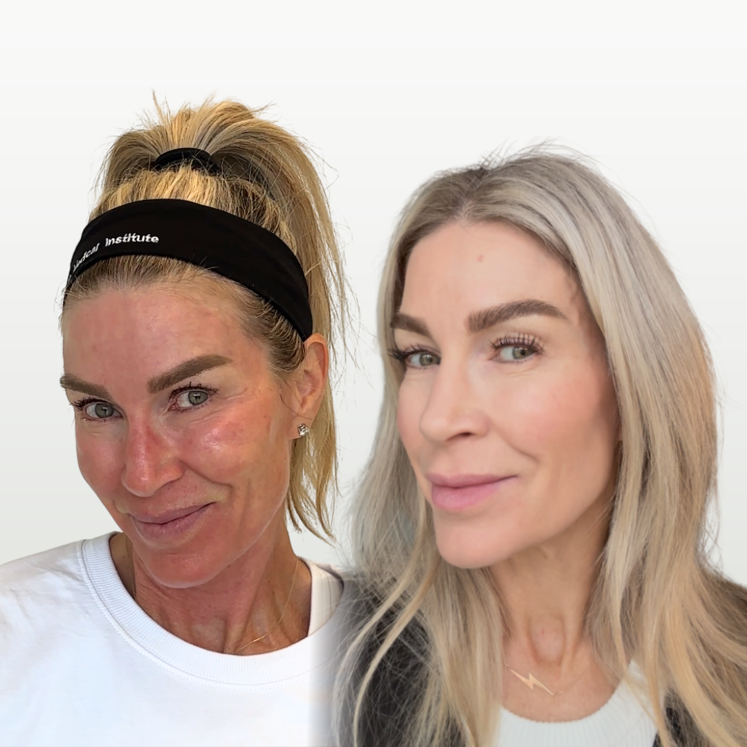 VAMP Microneedling Before and After