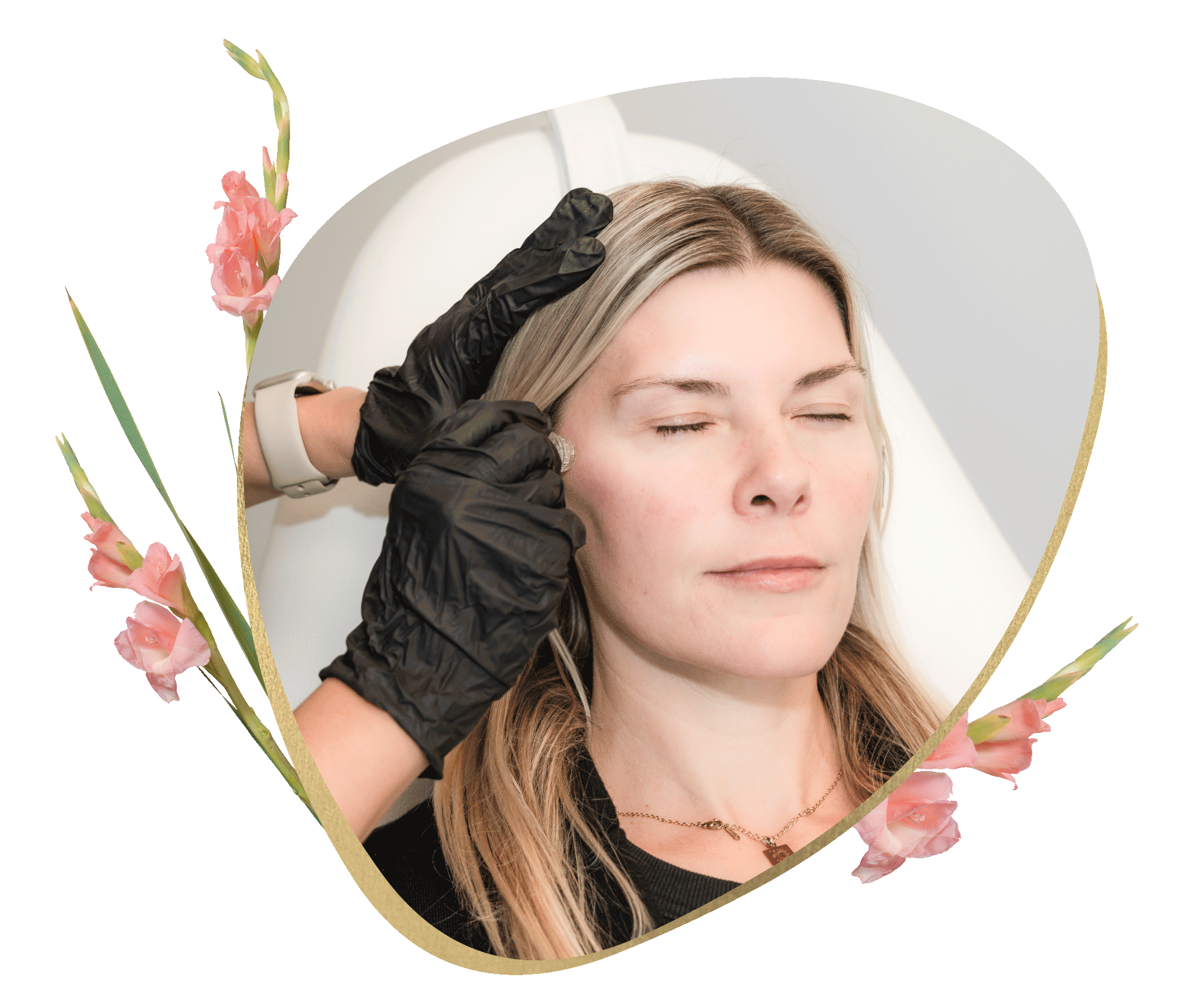 Clinician performing Aquagold Micro-Infusion treatment