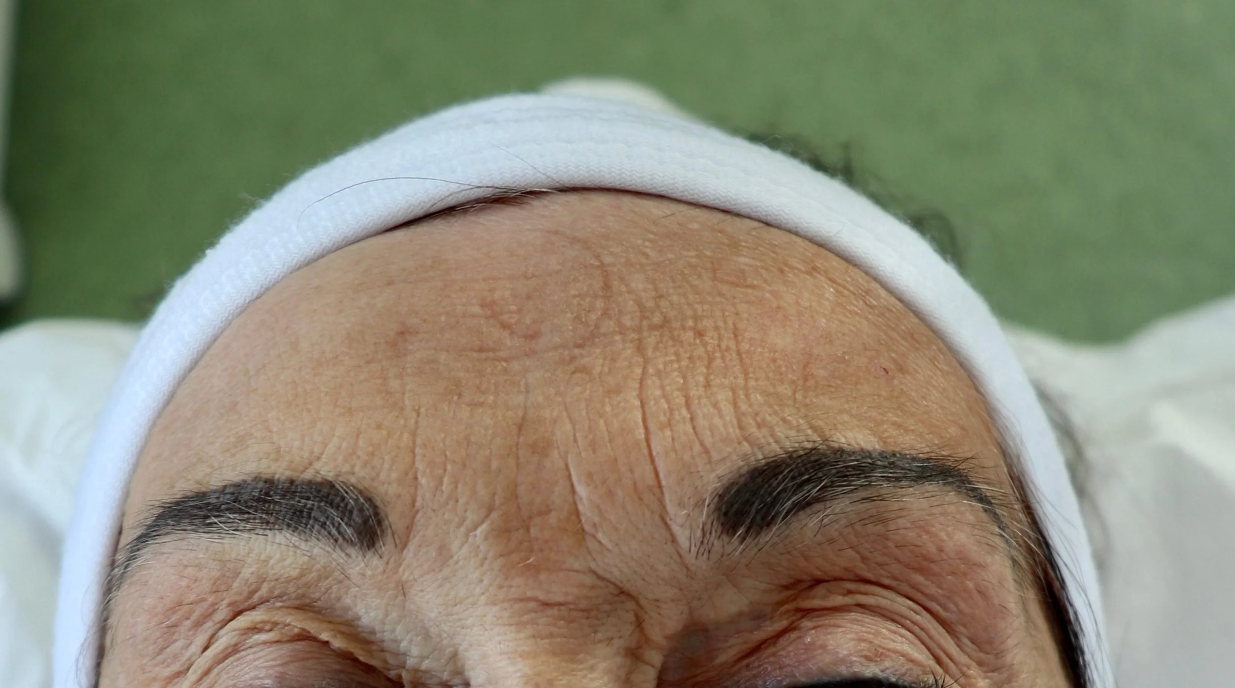 JetPeel Forehead Before Treatment Age 72