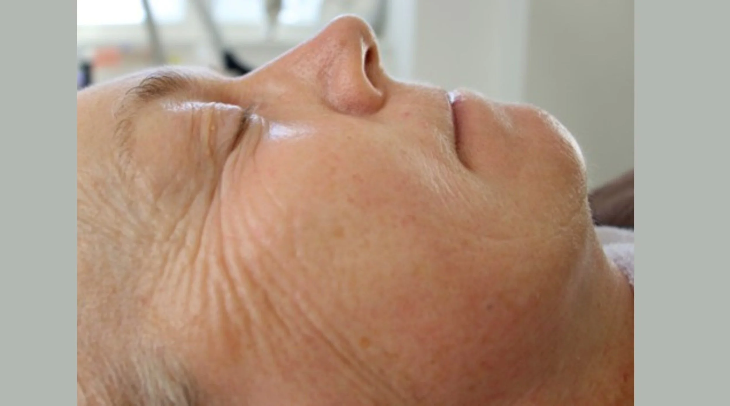 JetPeel After Treatment Age 75