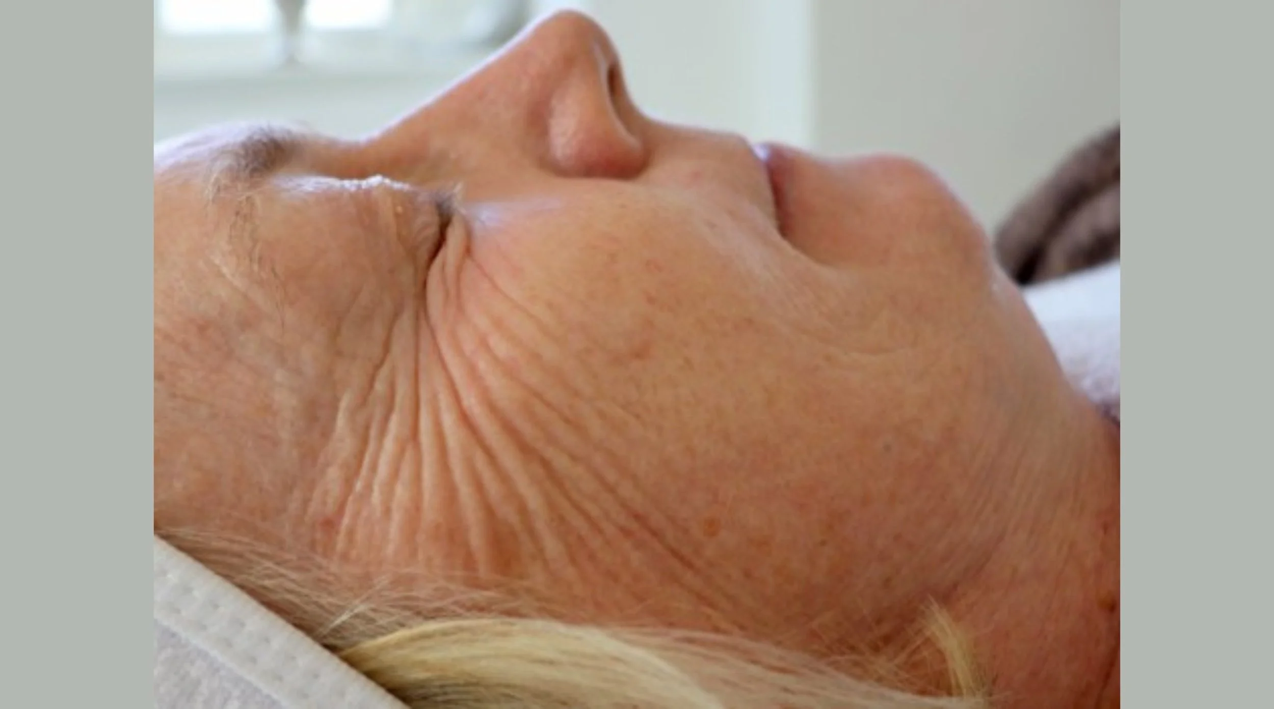 JetPeel Before Treatment Age 75