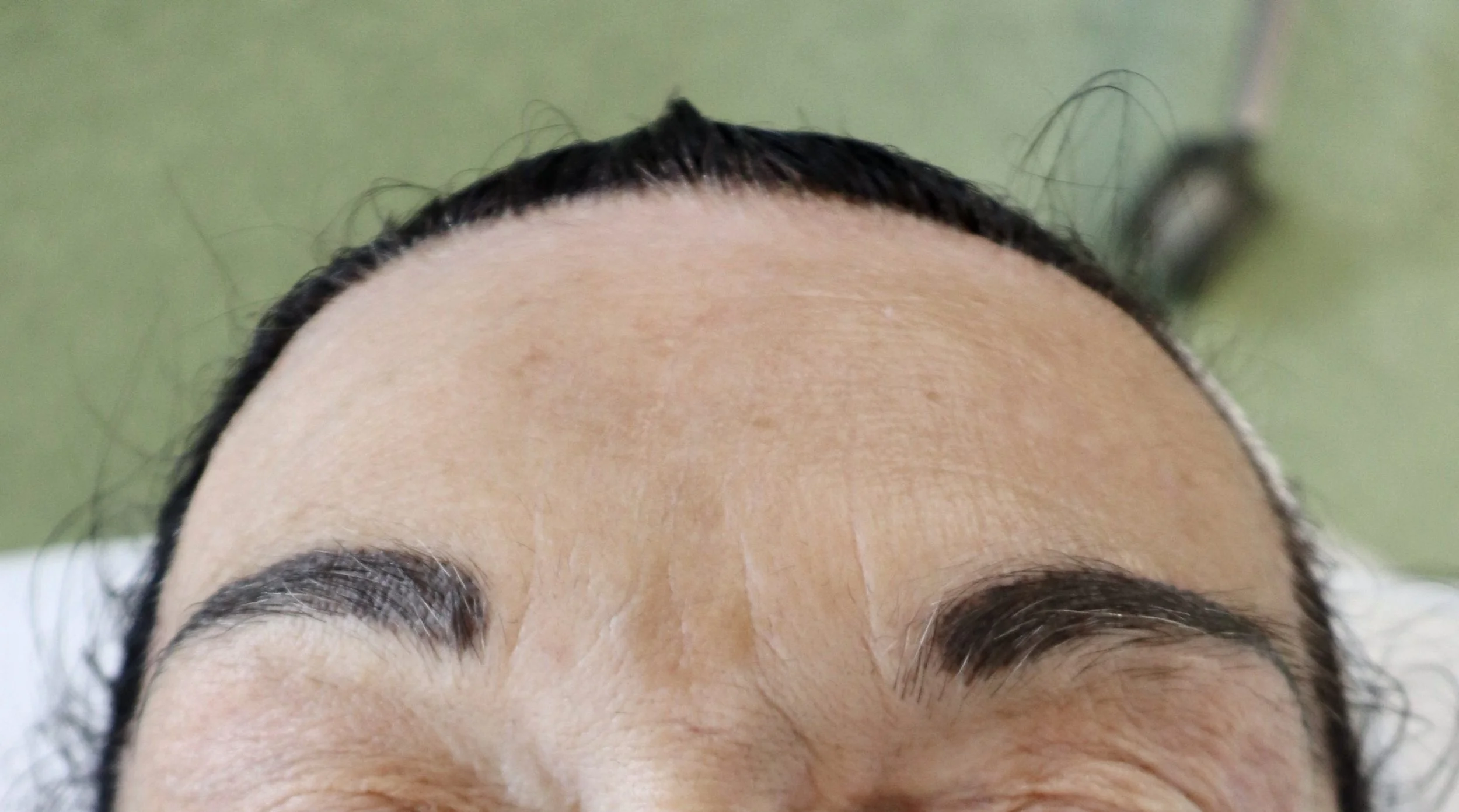JetPeel Forehead After Treatment Age 72