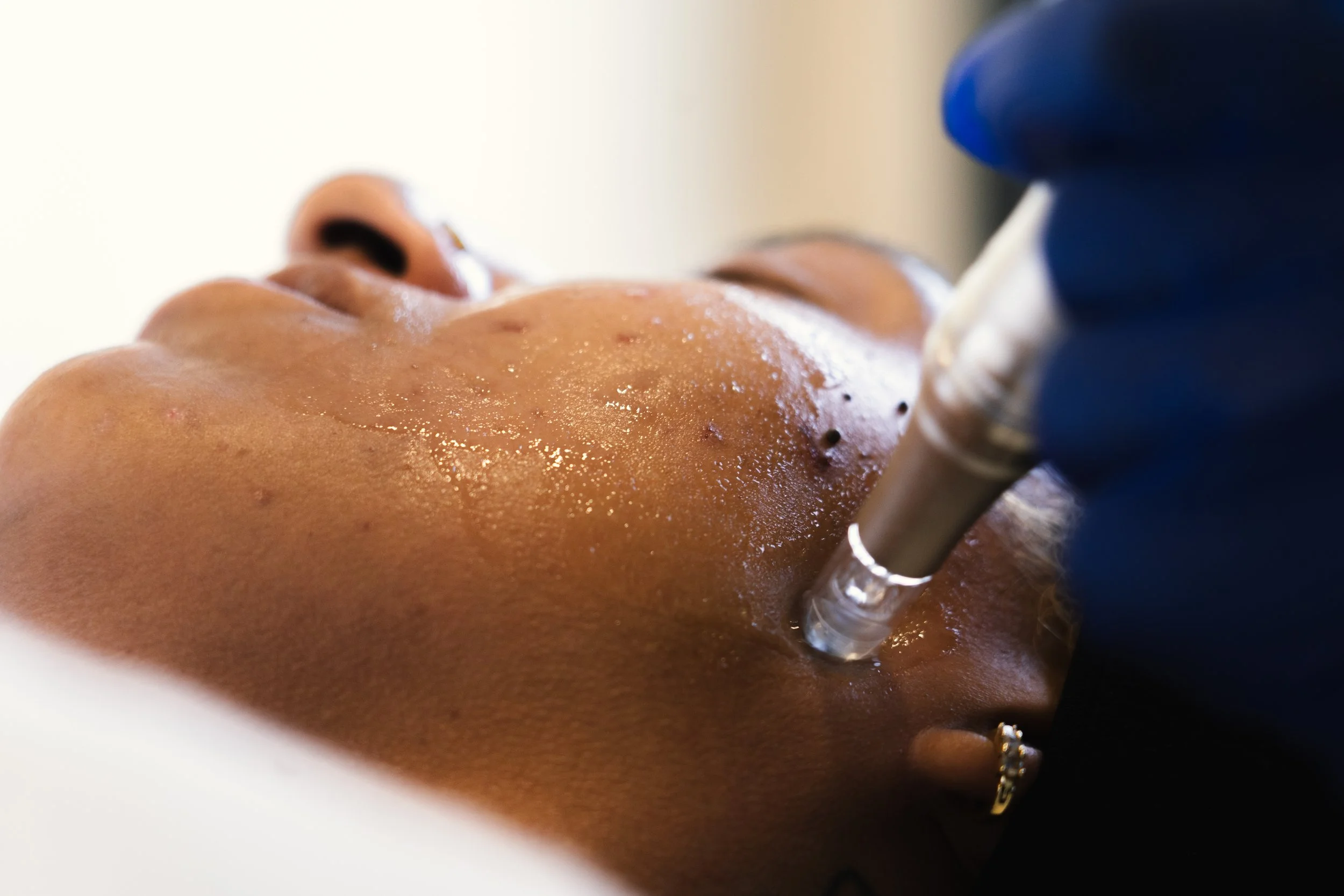 Microneedling