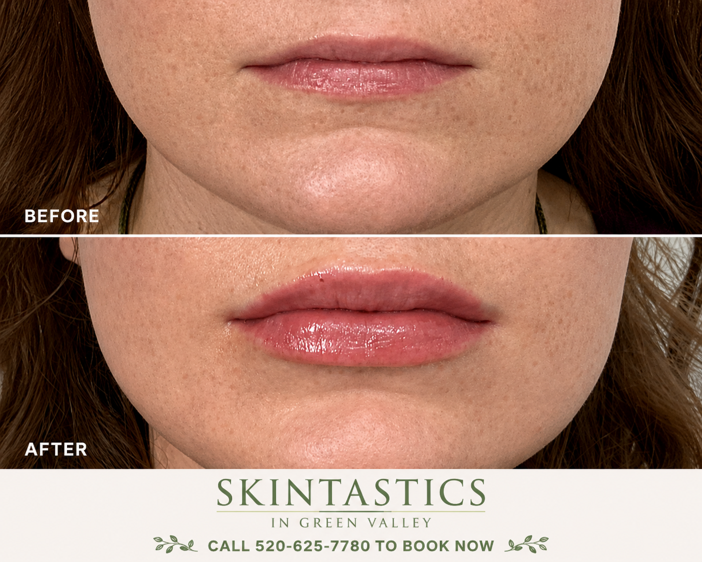 Dermal Filler