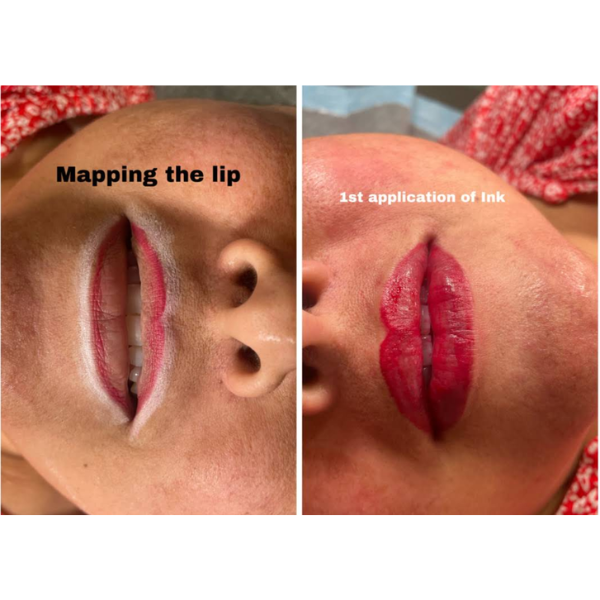 Lip Filler