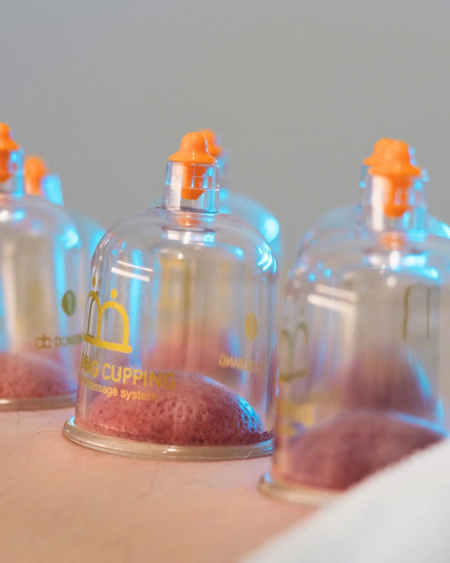 Cupping used as a soft-tissue technique at Optimum Health
