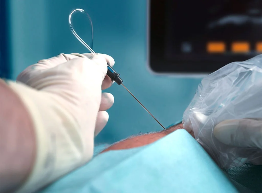 TOP NeuroPole-Neuromodulationssonden – Behandlung chronischer Schmerzen in der Schweiz