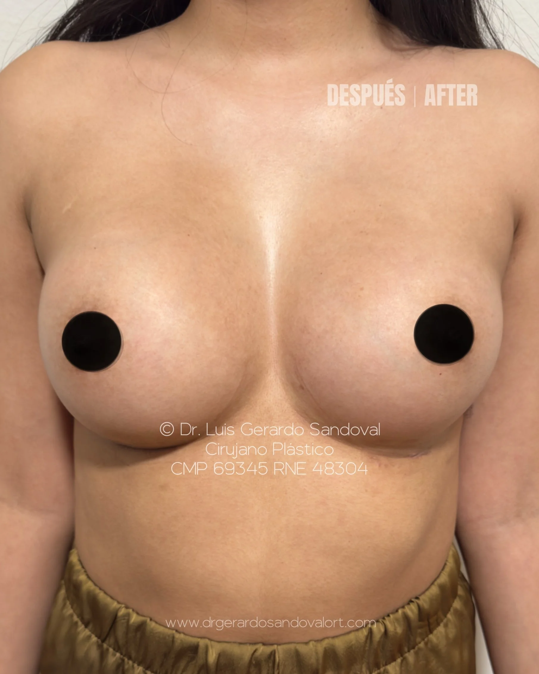 Después del aumento mamario con implantes Motiva® Ergonomix: 325cc Corse en mama izquierda y 275cc Full en mama derecha, resultado natural en paciente de Lima