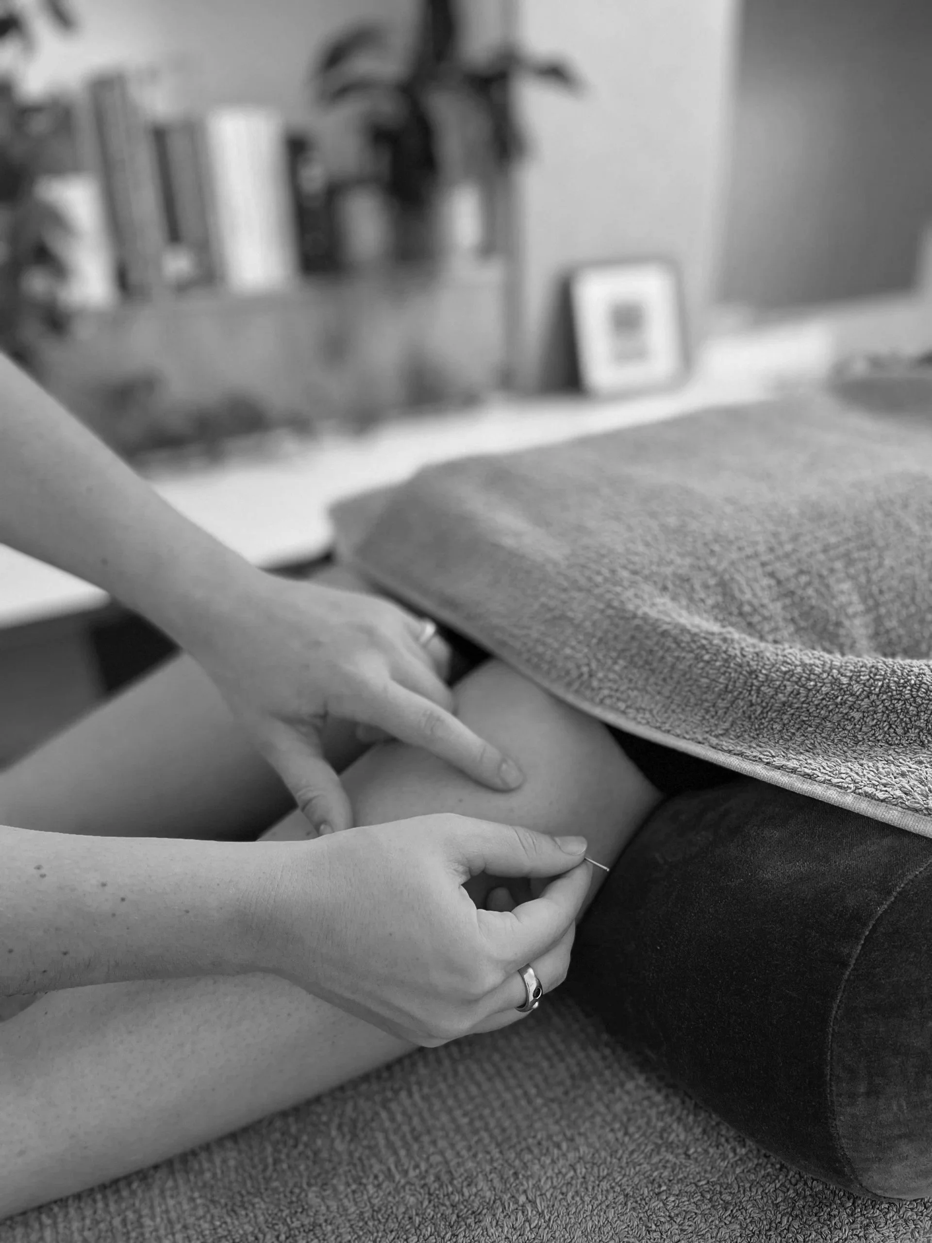 Acupuncture