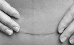 Gentle Scar Therapy