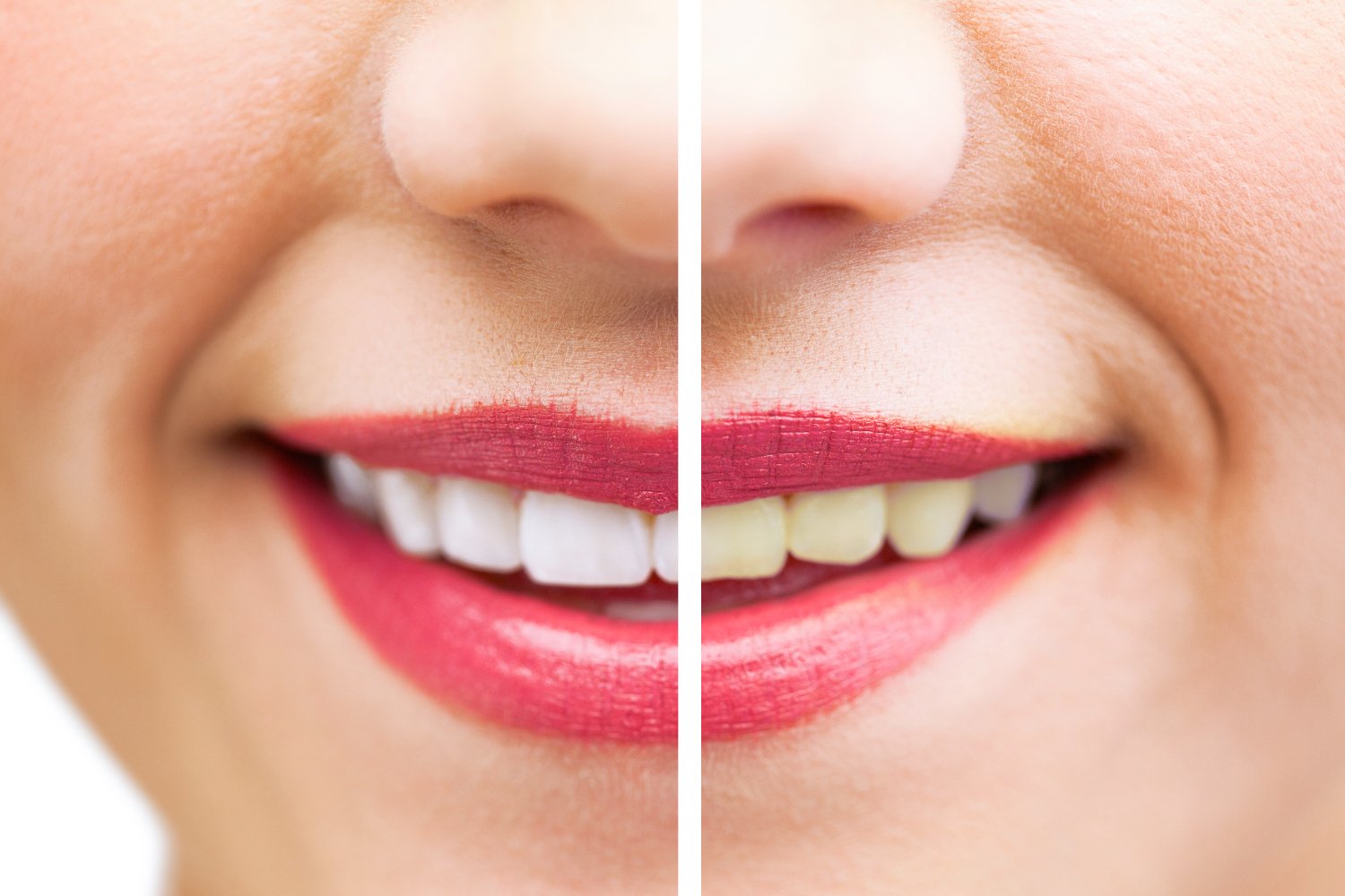 Limpieza dental Narvarte Del Valle