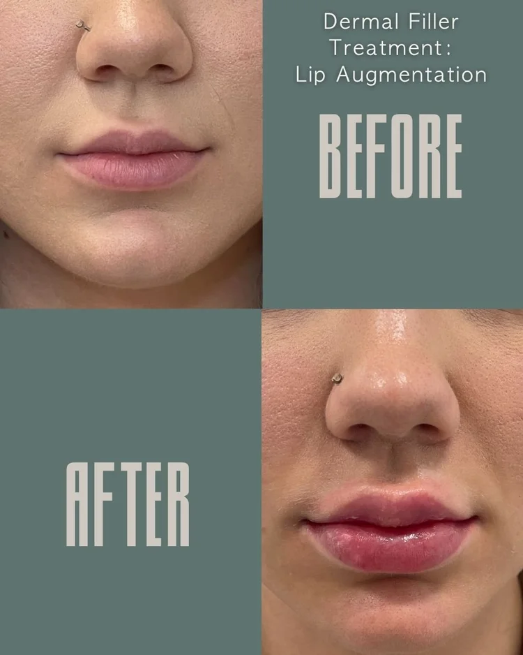 Lip filler before and after: lip augmentation at Panda Revival Lab in Surrey, patient result 2