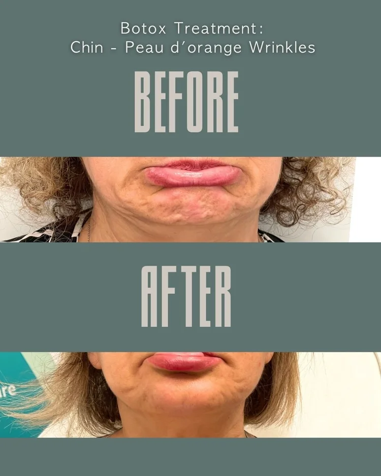 Botox before and after: chin peau d’orange wrinkles at Panda Revival Lab in Surrey