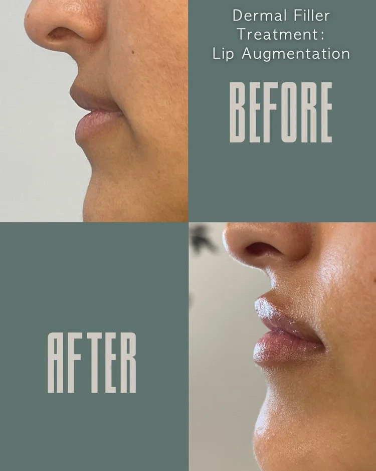 Lip filler before and after: lip augmentation at Panda Revival Lab in Surrey, patient result 5