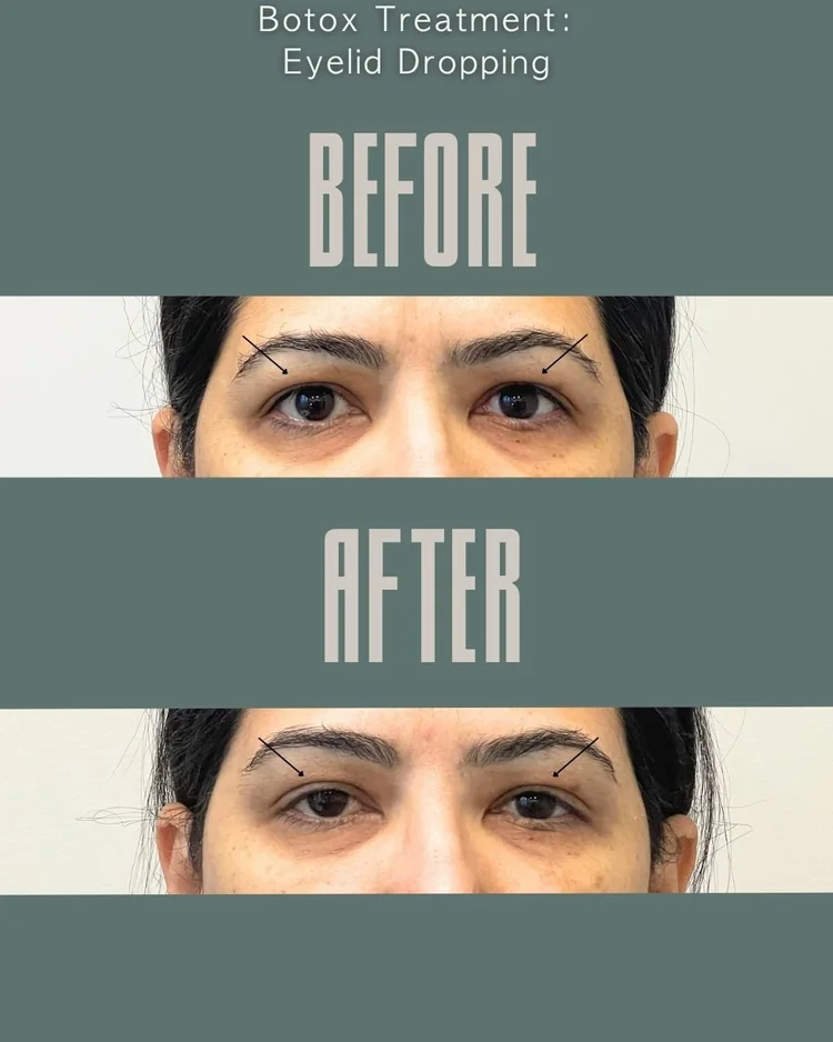 Botox before and after: eyelid drooping at Panda Revival Lab in Surrey