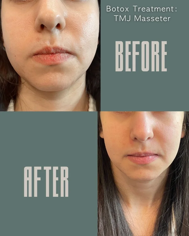 Botox before and after: TMJ masseter at Panda Revival Lab in Surrey