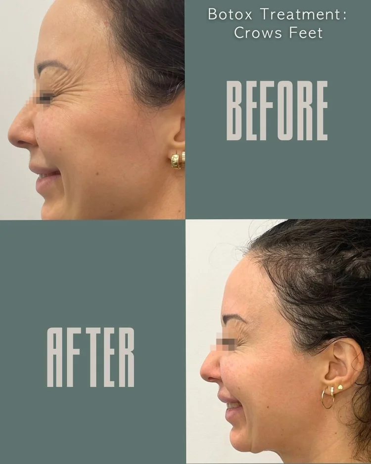 Botox before and after: crow’s feet at Panda Revival Lab in Surrey