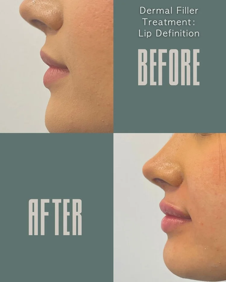 Lip filler before and after: lip definition at Panda Revival Lab in Surrey, patient result 1