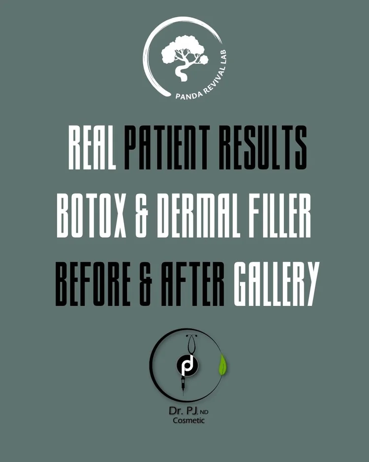 Real patient results: Botox and dermal filler before and after by Dr. PJ Azad at Panda Revival Lab in Surrey