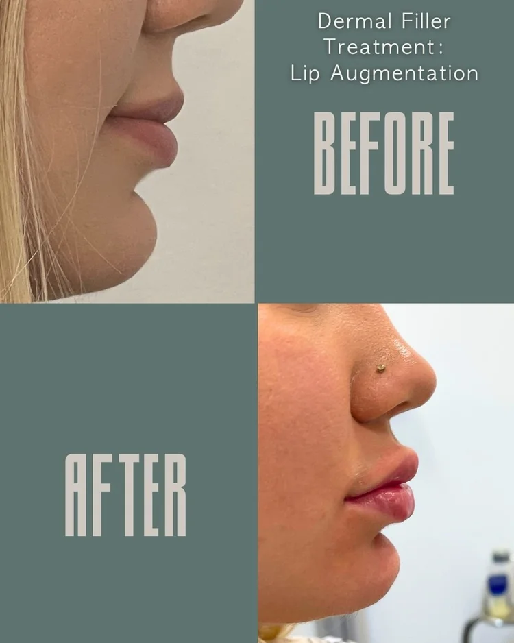Lip filler before and after: lip augmentation at Panda Revival Lab in Surrey, patient result 4