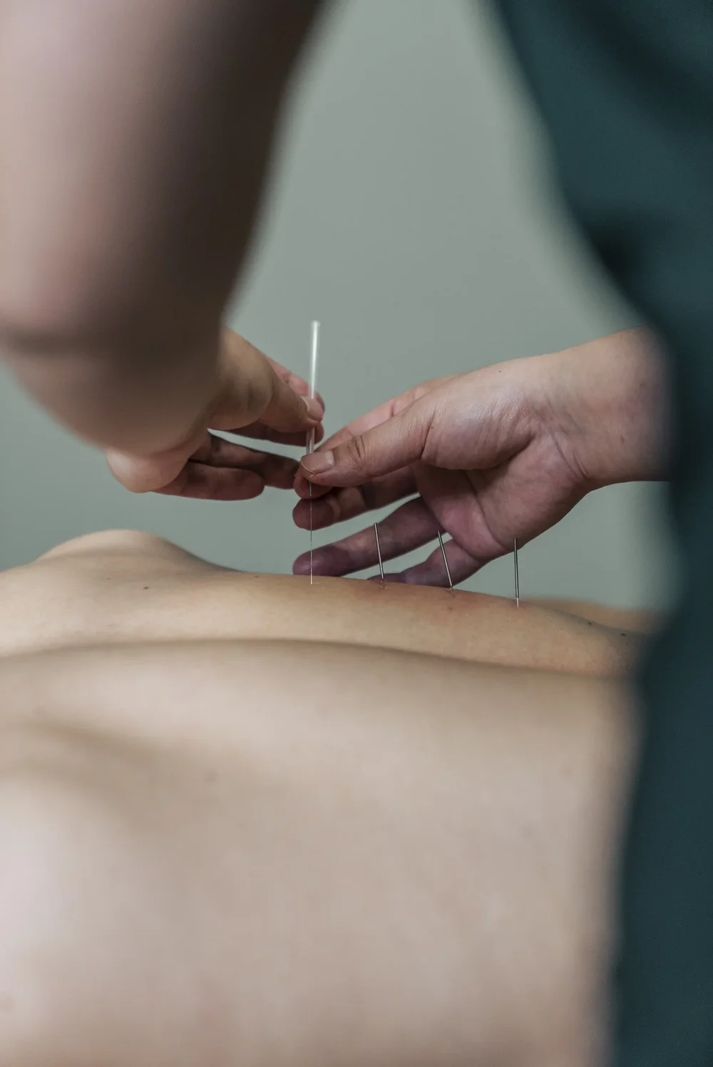 Acupuncture at Panda Revival Lab in Surrey