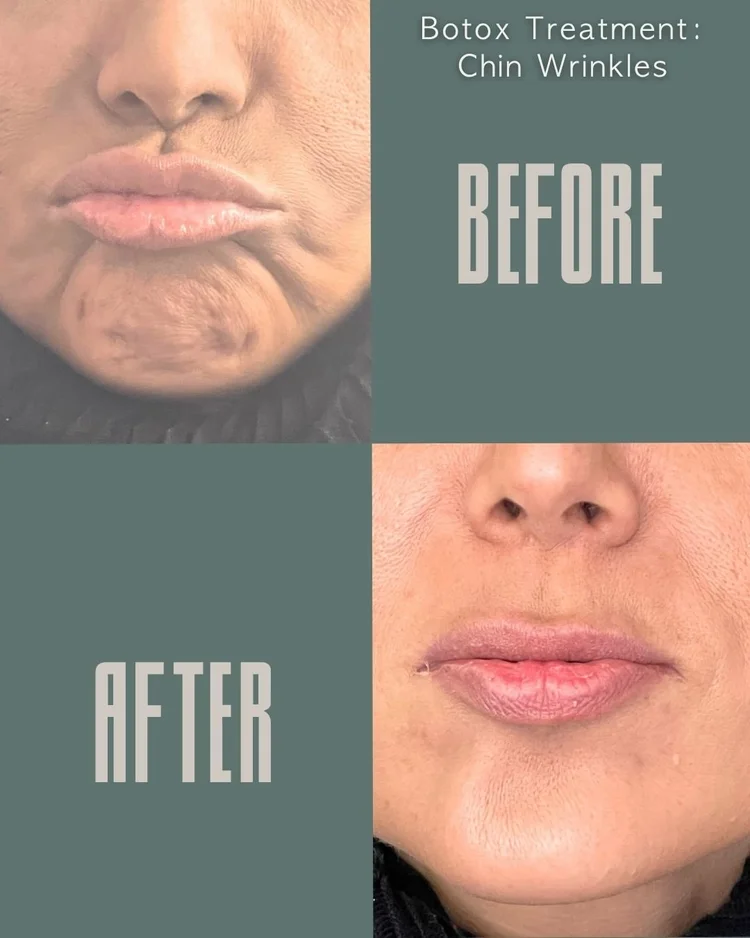 Botox before and after: chin wrinkles at Panda Revival Lab in Surrey