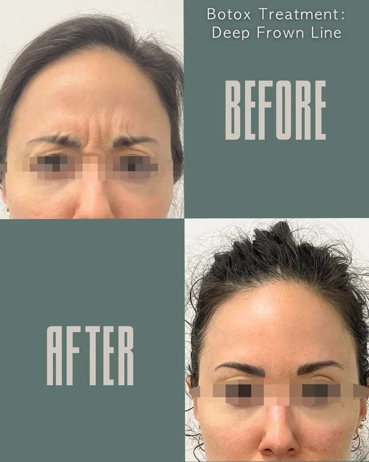 Botox before and after: deep frown lines at Panda Revival Lab in Surrey