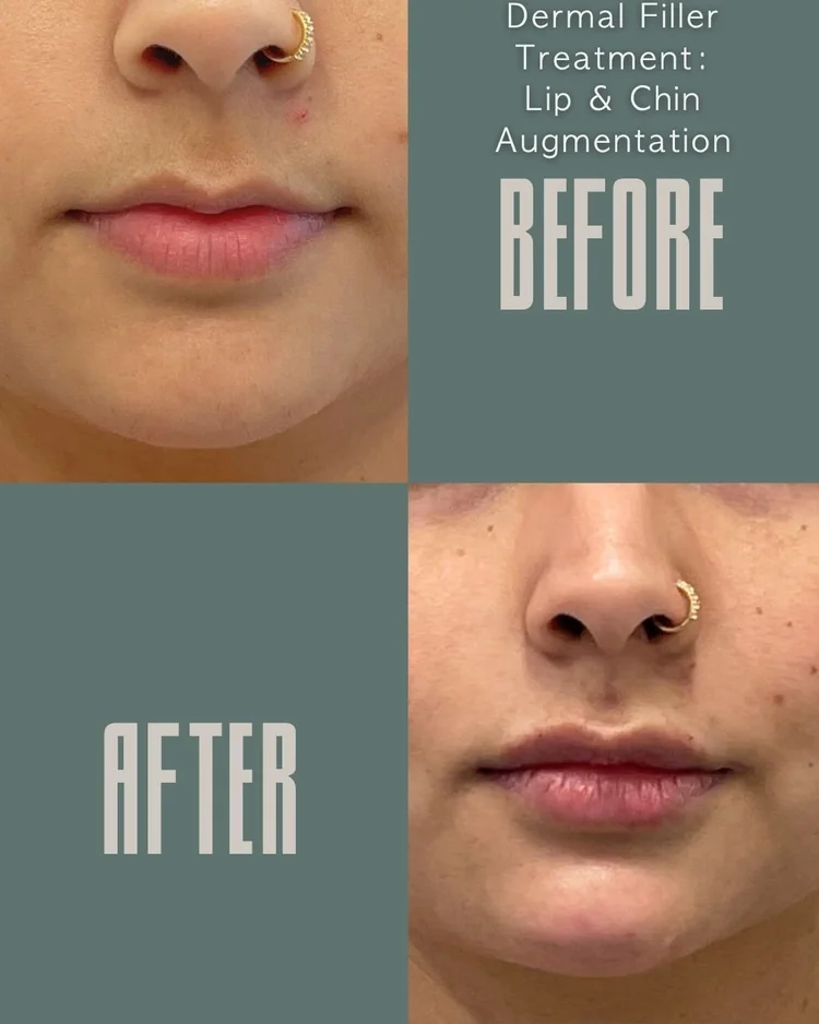 Dermal filler before and after: lip and chin augmentation at Panda Revival Lab in Surrey, patient result 1