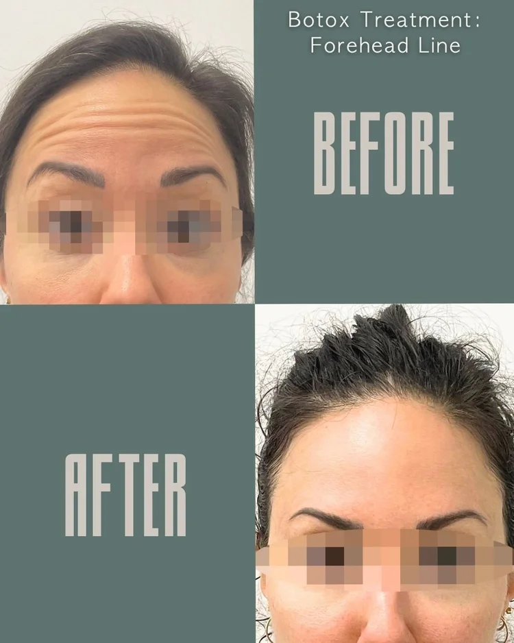 Botox before and after: forehead lines at Panda Revival Lab in Surrey
