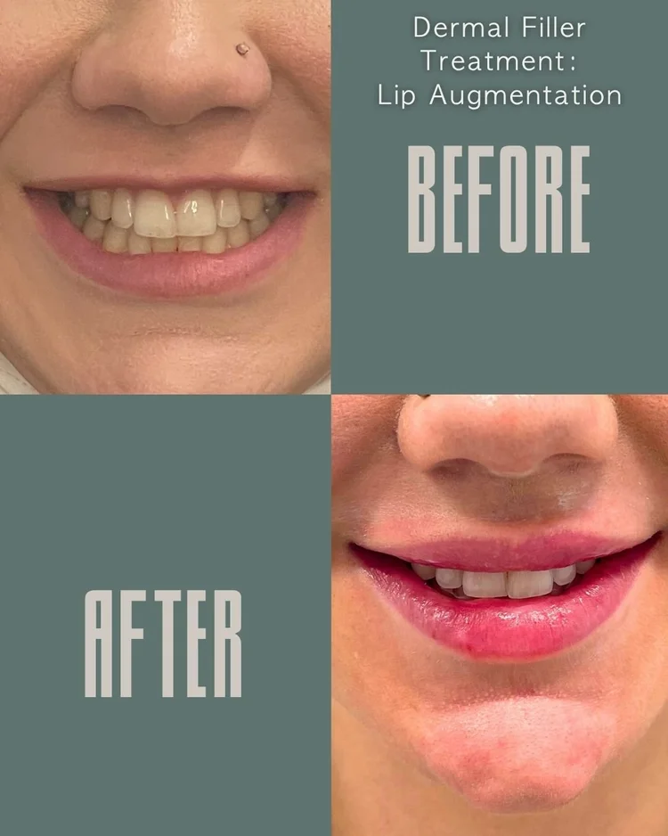 Lip filler before and after: lip augmentation at Panda Revival Lab in Surrey, patient result 3