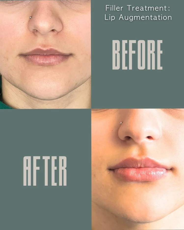 Lip filler before and after: lip augmentation at Panda Revival Lab in Surrey, patient result 1