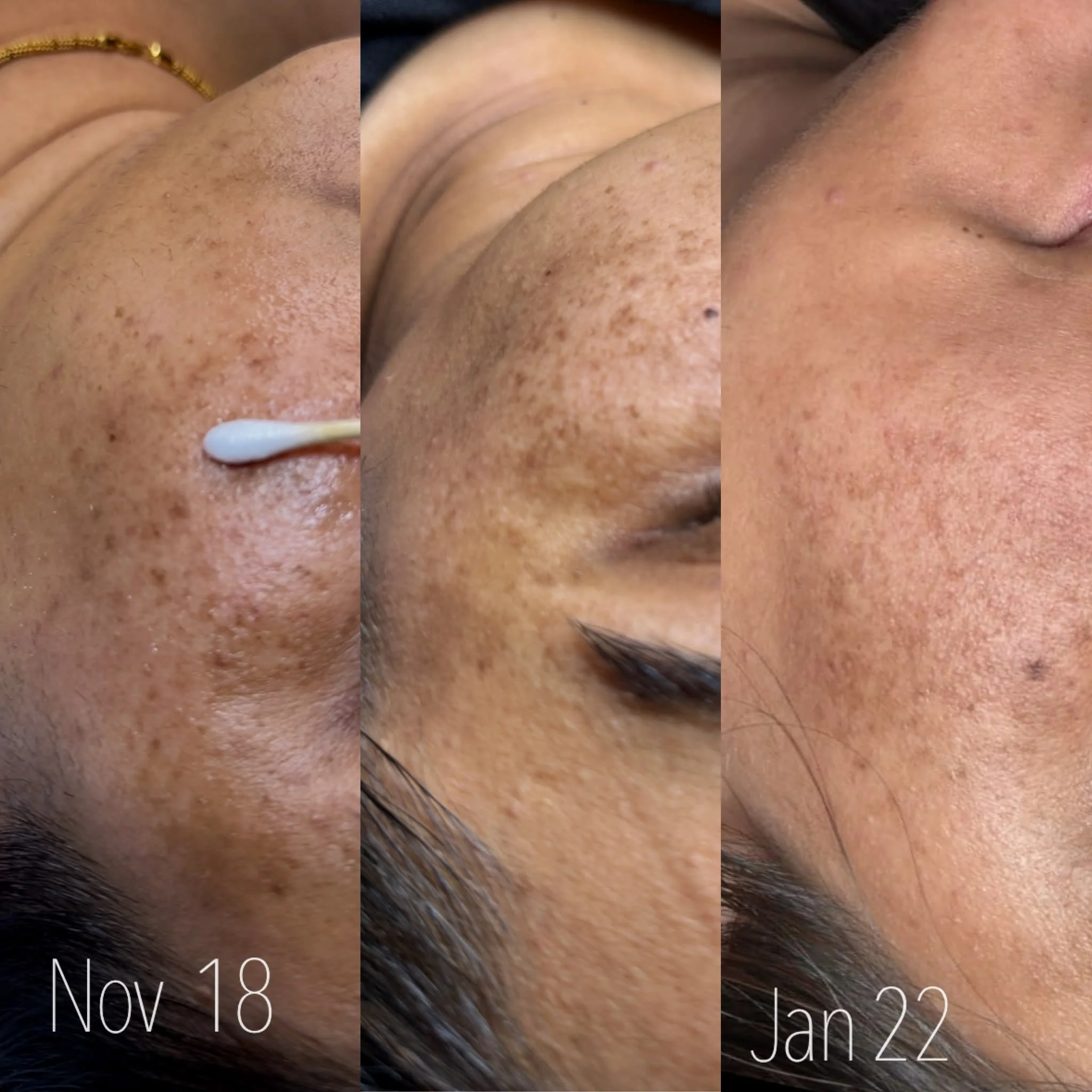 Melasma treatment before and after in Brampton