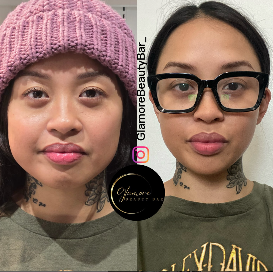 Masseter Botox jawline slimming at Glamore Beauty Bar Skin and Laser Clinic in Brampton