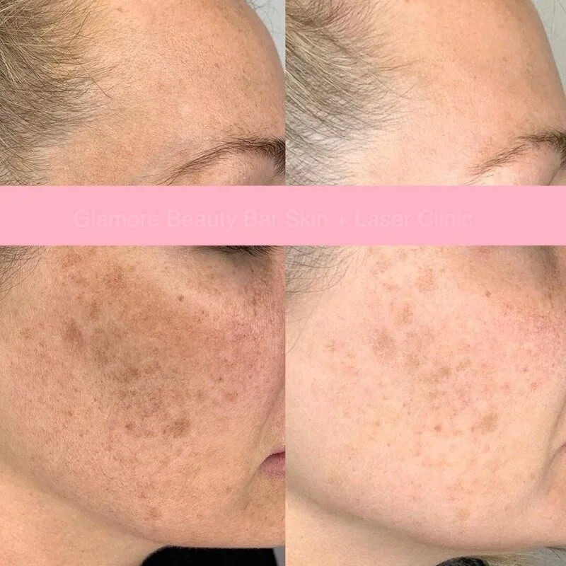 Sun damage pigmentation treatment before and after in Brampton