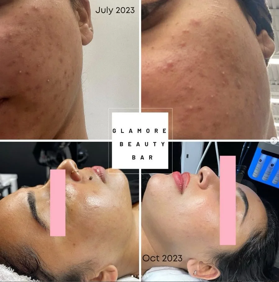 Signature microneedling before and after result in Brampton