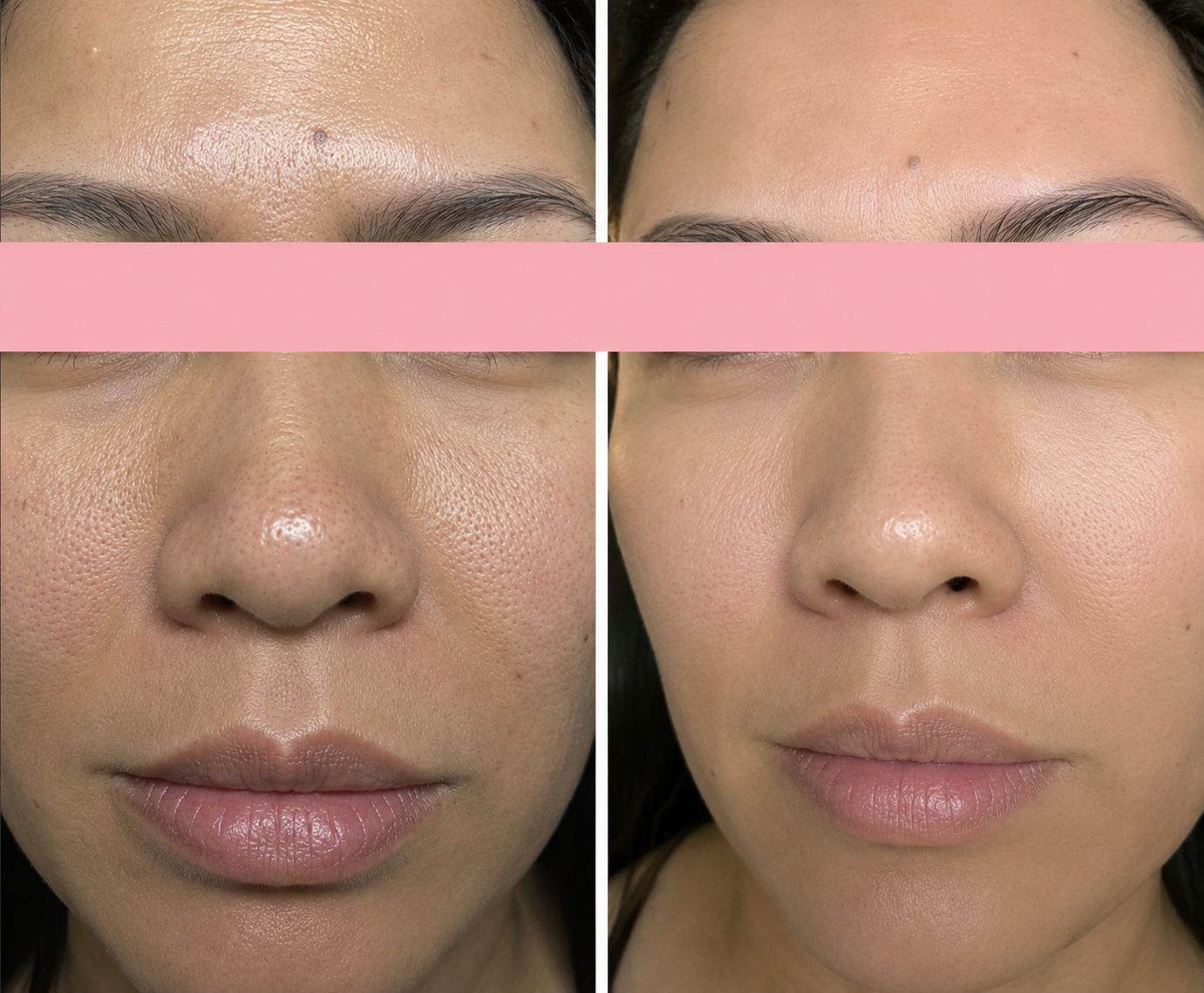 Enlarged pores before and after microneedling skin texture improvement