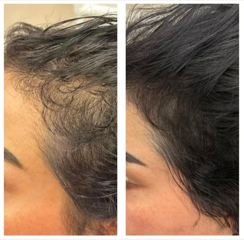 Hair Restoration