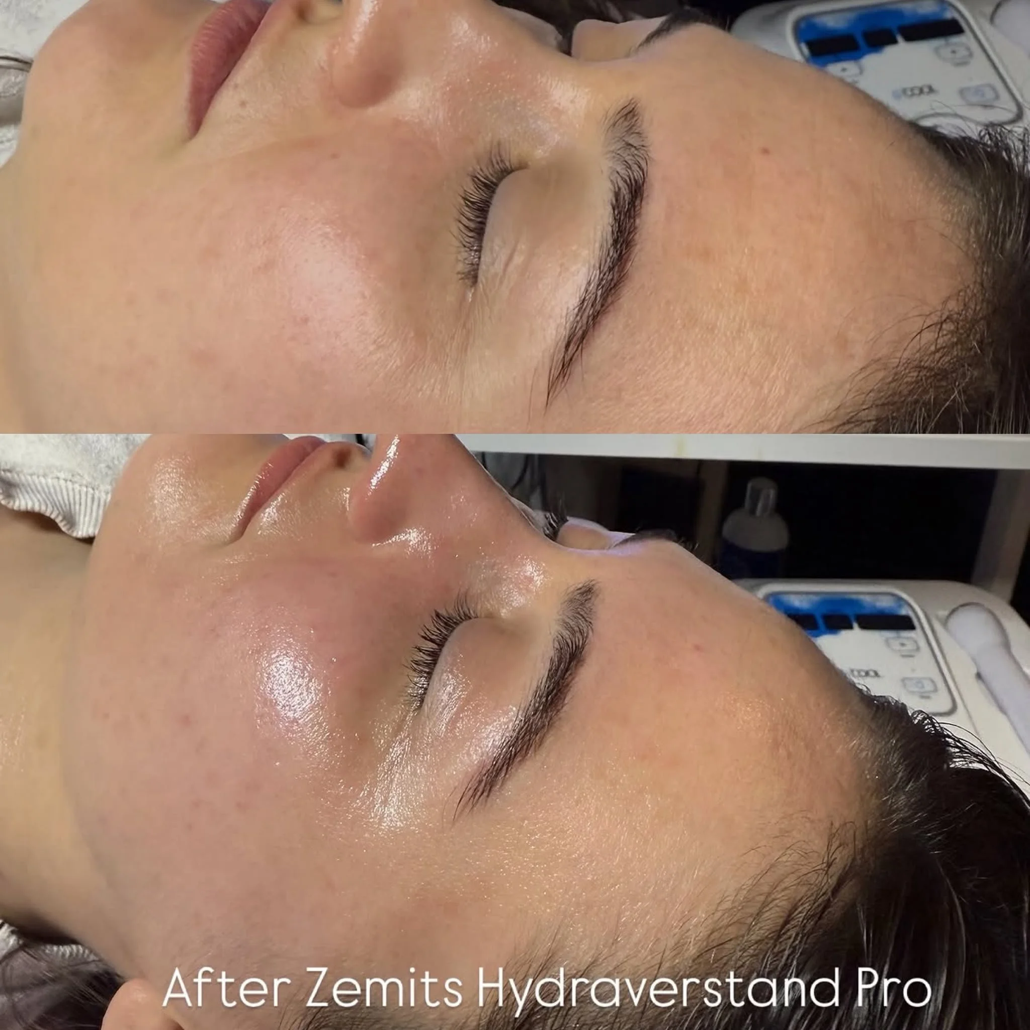 Hydradermabrasion facial treatment result in Brampton
