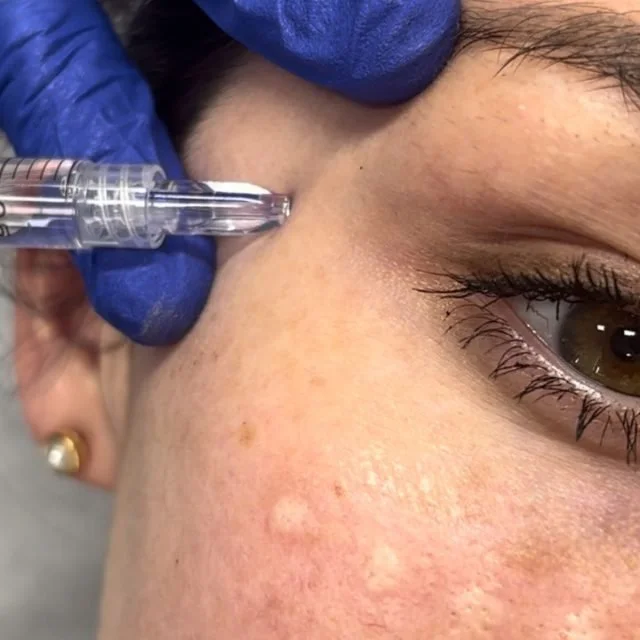 NCTF injection near the eye