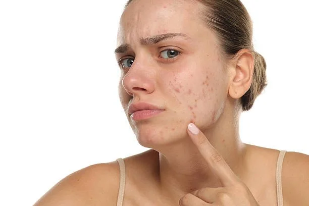 Woman with acne touching her cheek