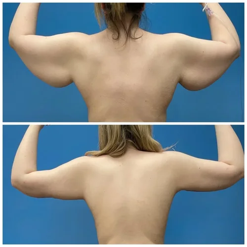 Arm lift before and after in Torrance