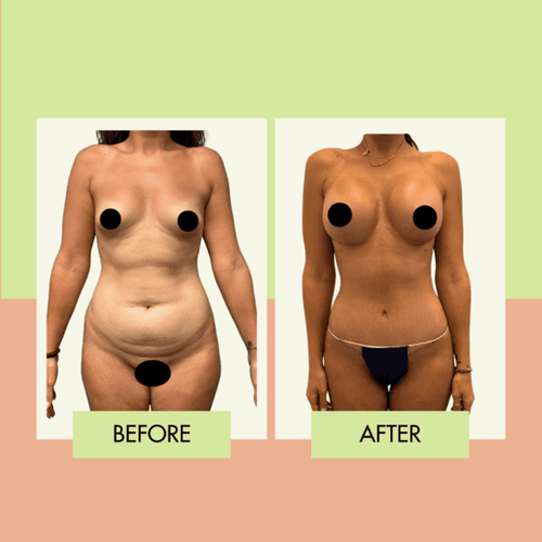 Mommy makeover before and after in Torrance and the South Bay