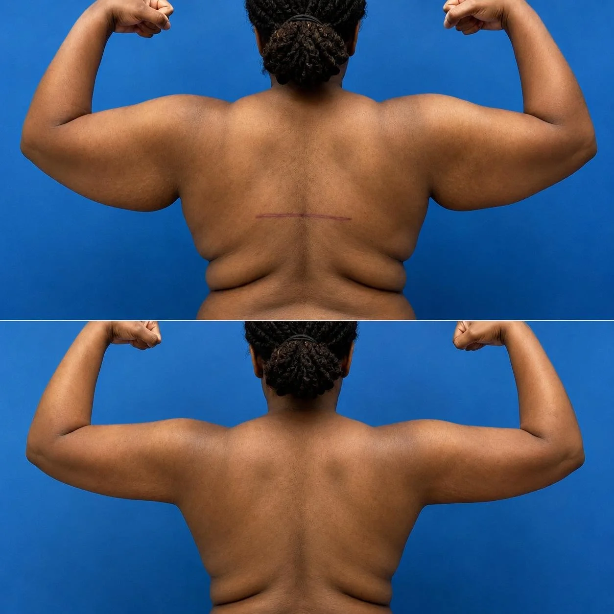 Arm lift results Torrance Los Angeles