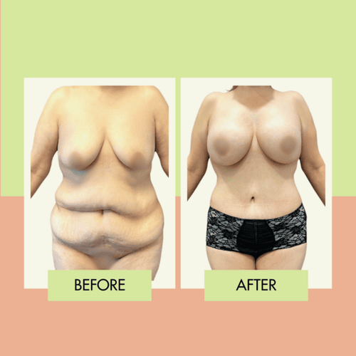 Mommy makeover before and after at Adonis Plastic Surgery