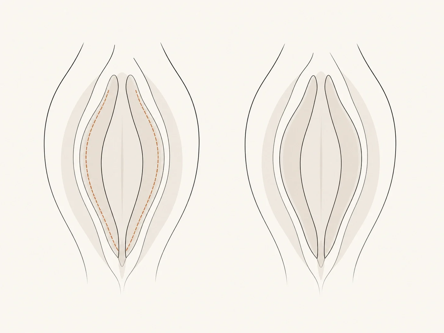 Educational vector diagram of the trim labiaplasty technique