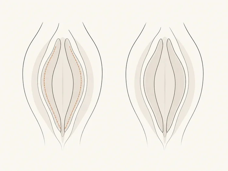 Educational vector diagram of the trim labiaplasty technique