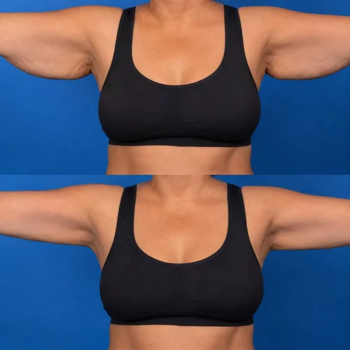 Brachioplasty before and after at Adonis Plastic Surgery