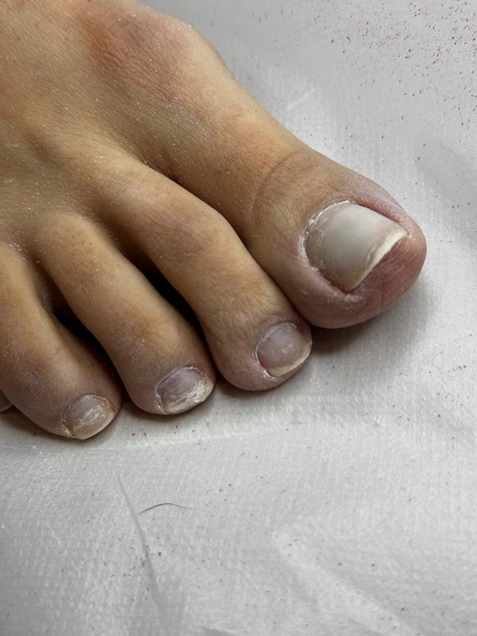 Toenails with lifting product before treatment